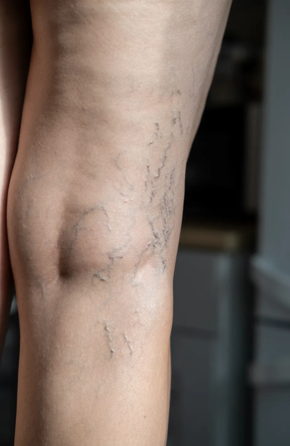 What Are Varicose Veins? Causes, Symptoms and Modern Treatments