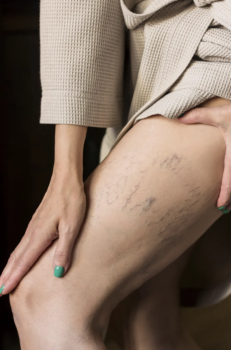 Who Is More Likely to Develop Varicose Veins? Risk Factors and Prevention Methods